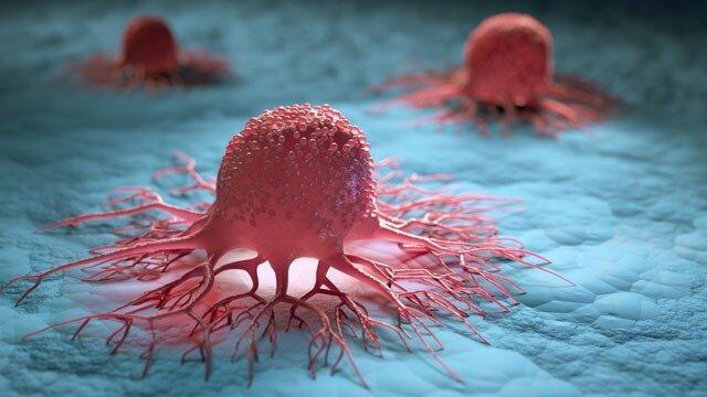 سرطان پروستات چگونه متاستاز می نماید؟