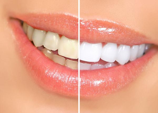 آیا سفید کردن دندان ها با کیت های سفیدکننده مضر است؟